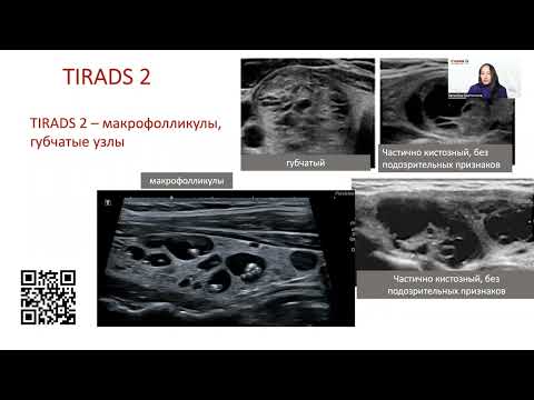 Как на практике применять систему отчетности TI-RADS врачу УЗД?
