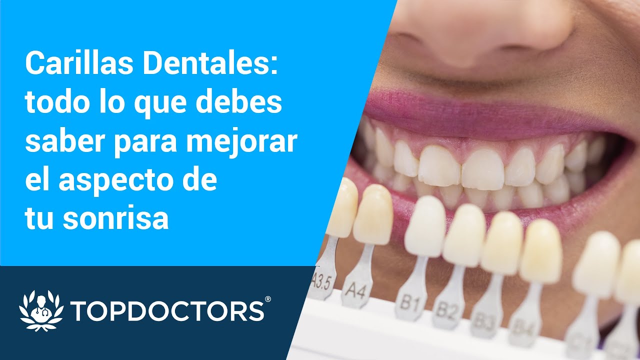 Todo lo que debes saber sobre Carillas Dentales