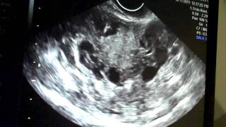 Baby #2 Ultrasound - 9 weeks 5 days.