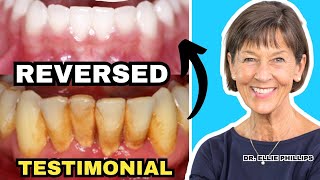 Gum Recession and Bone Loss Reversed (Testimonial)