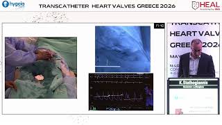 K. Stathogiannis | Live-in-a-box case 2: Aortic stenosis with small root anatomy​