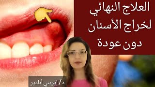 كيفية علاج خراج الأسنان و الضروس نهائياً دون عودة