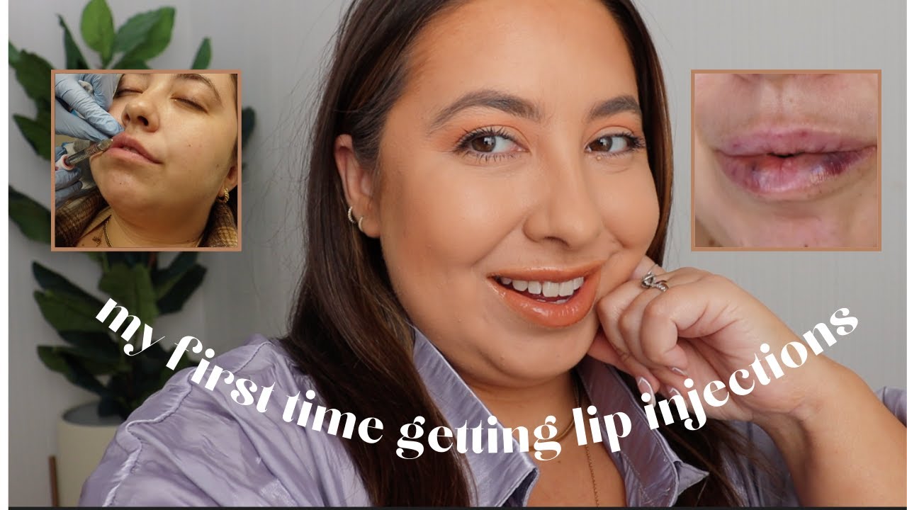 my FIRST time getting Lip Injections! | 1 Syringe Juvaderm Lip Filler!!