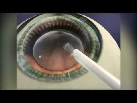 Implantable Contact Lens