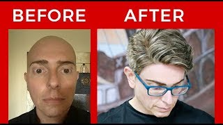 Best Hair Transformationman Hair System-Protesis Capilar Alopecia Areata-Protesi Capelli Uomo