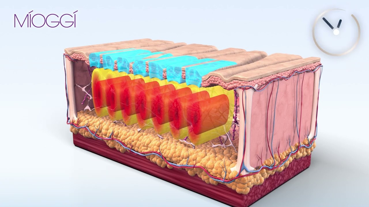 Sofwave立體超聲波拉提效果｜最優惠價錢｜MIOGGI | MÍOGGÍ MediCentre｜醫學輕齡專家｜香港醫學美容中心首選