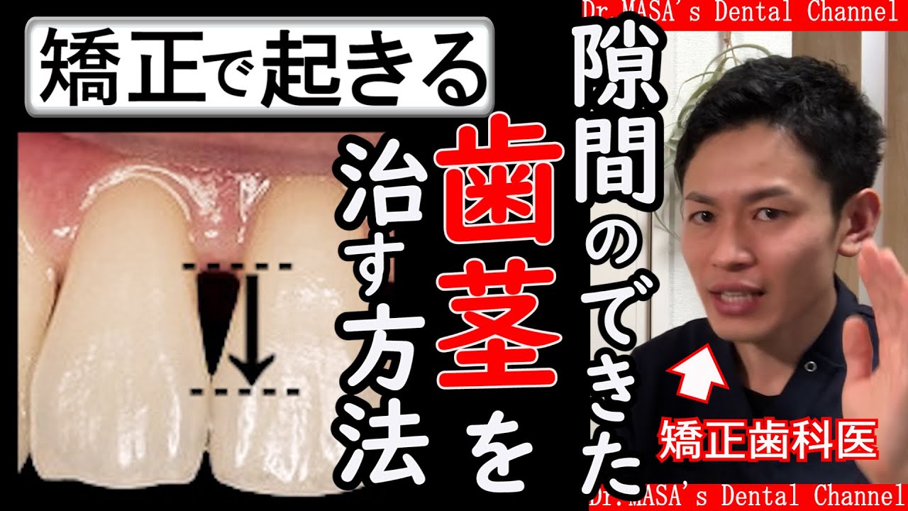 【20代でも要注意】ブラックトライアングルの治し方【４選】