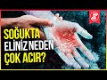 Ellerimiz Soğukta Neden Daha Çok Acır?