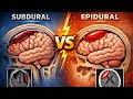 مقایسه ساب دورال و اپی دورال 