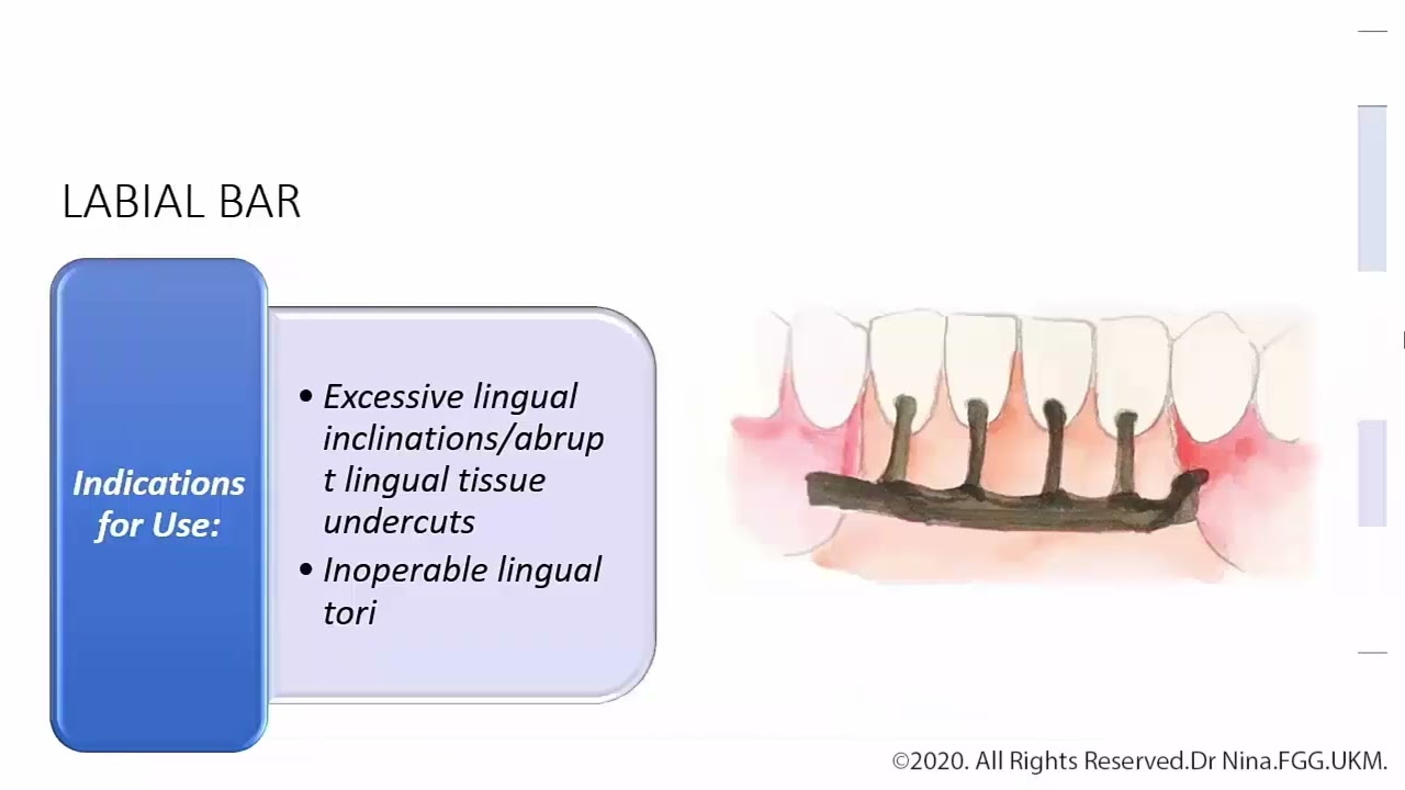Co-Cr RPD Design  Part 1: Components of RPD