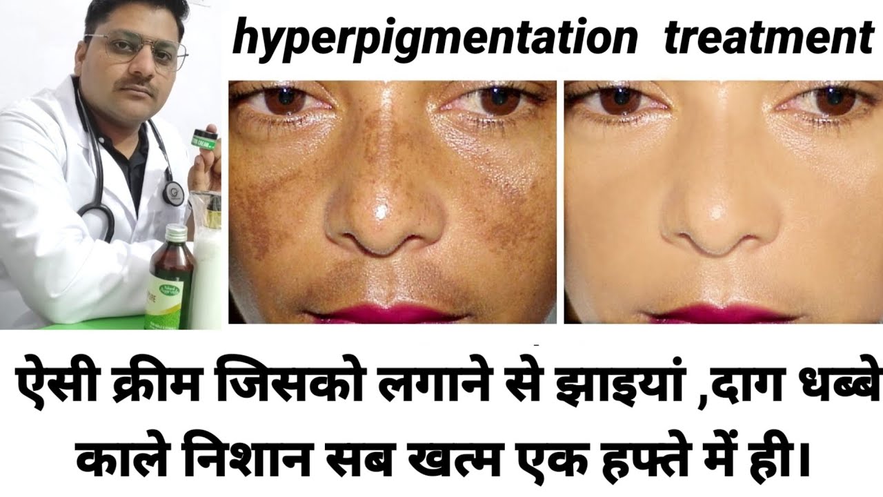 Pigmentation Removal Cream || झाइयों के लिए एकमात्र आयुर्वेदिक क्रीम जो जड़ से खत्म करें