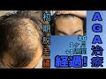 AGA治療1ヶ月+1週間経過！日に日に初期脱毛で薄くなるのが怖い…