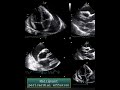 Malignant pericardial effusion