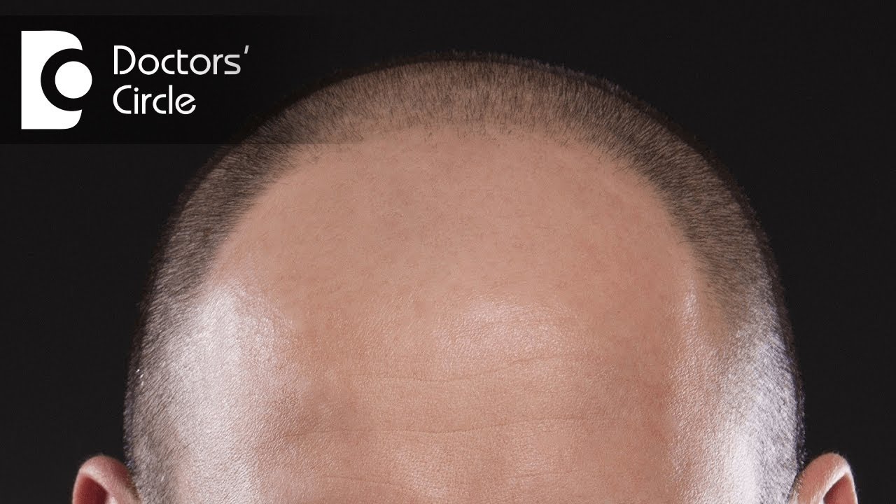 How To Treat Diffuse Alopecia In Young Men Dr Aruna Prasad