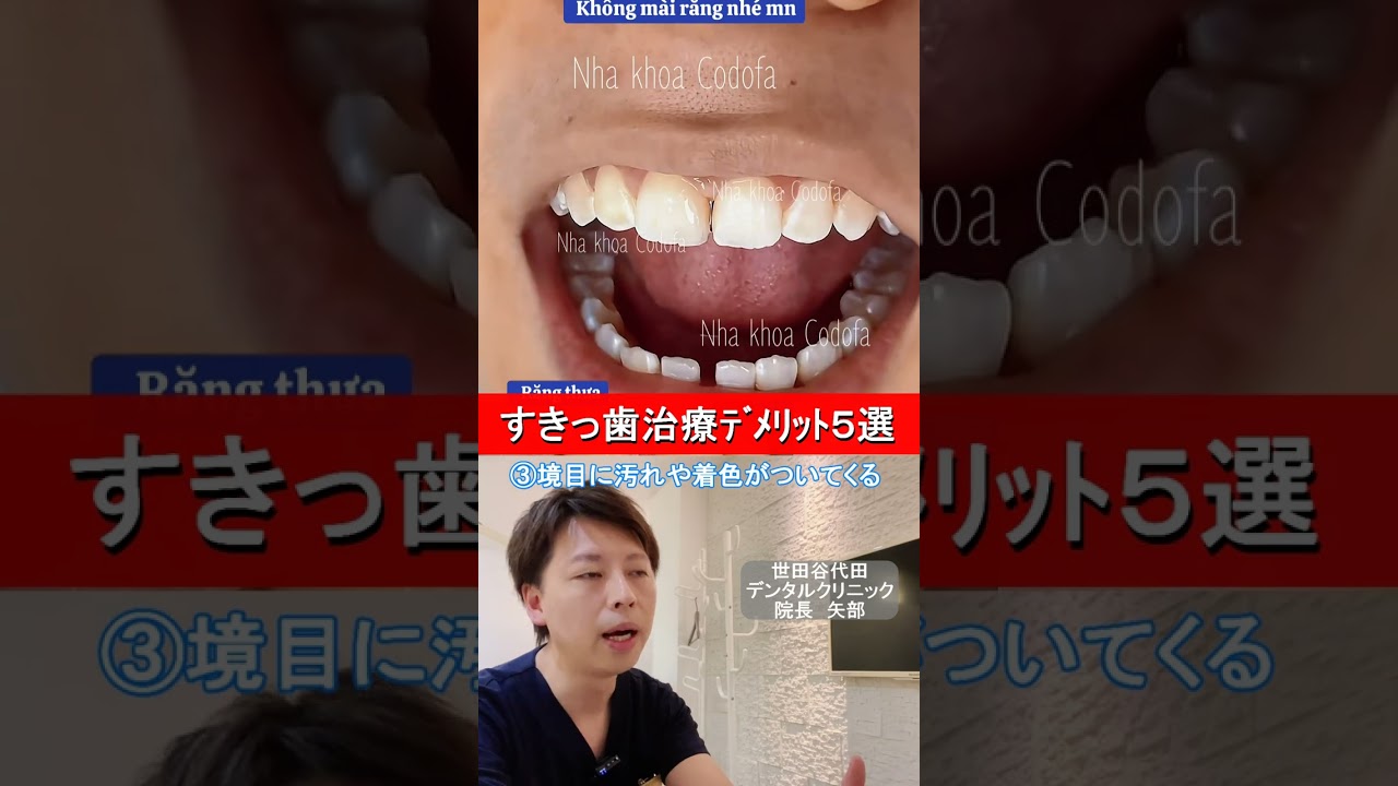 すきっ歯治すベニア治療のデメリット5選★#ベニア治療 #セラミック #審美歯科 #芸能人の歯 #歯並び #前歯 #歯を削る