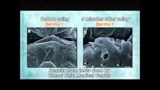 Hi-Tech Lnh Skin Care Device- Skin Scrubberderma-F Acne Therapy Devicedana-A