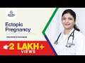 Ectopic Pregnancy | Causes, Signs, Symptoms & Treatment | एक्टोपिक प्रेगनेंसी क्या है लक्षण और कारण