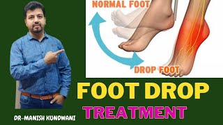 Foot Drop Treatment By Electro Dry Needling STIMULATION#midasphysiocare #footdrop#drmanishkundwani