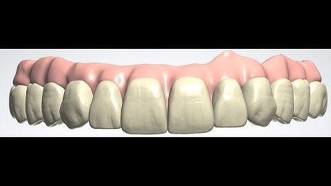 implant hybrid bridge Design  step by step coming soon