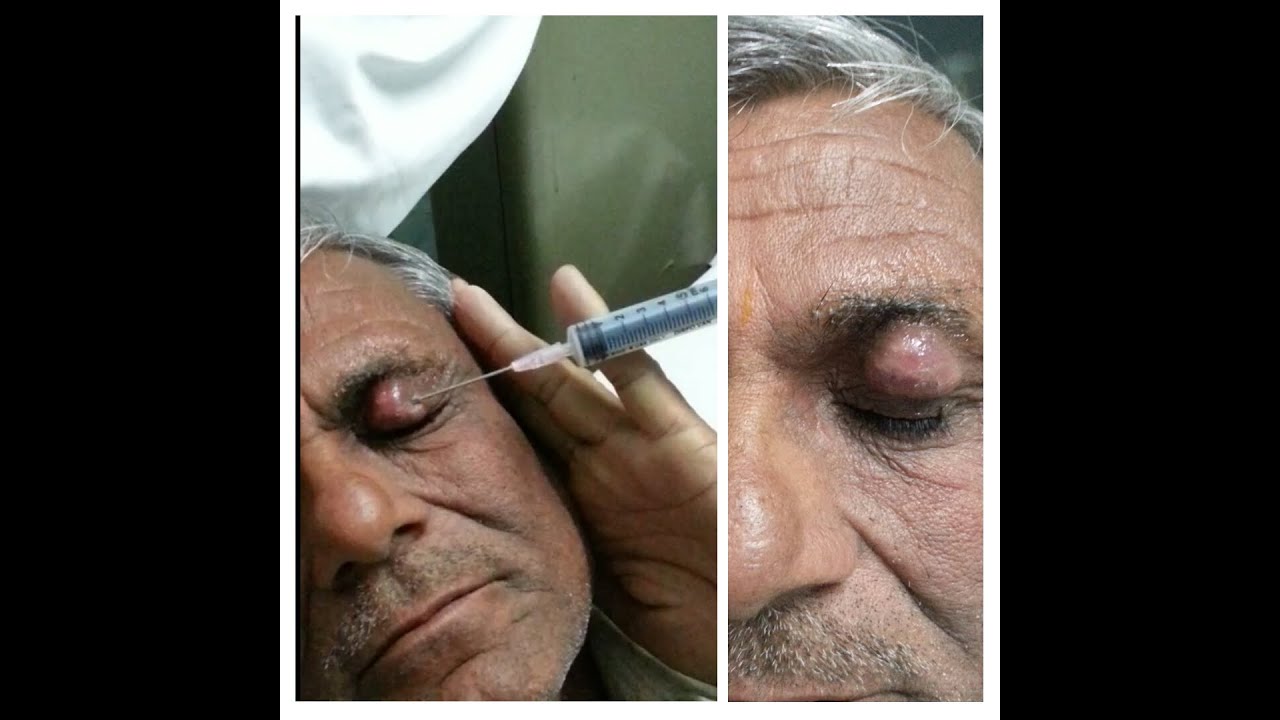 Abscess around left eye lid YouTube