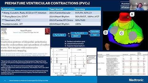 Qingguo Zeng (Medtronic) - CardioInsight ECGI Clinical Validation
