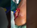 # Retromuscular (behind the Triceps) Large Lipoma abutting the radial nerve , excised successfully.