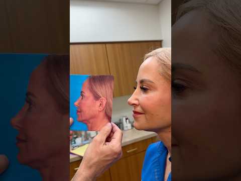 Video thumbnail: Revision Rhinoplasty Finesse- 3rd time is a charm! · Rod J. Rohrich, M.D. Plastic Surgeon