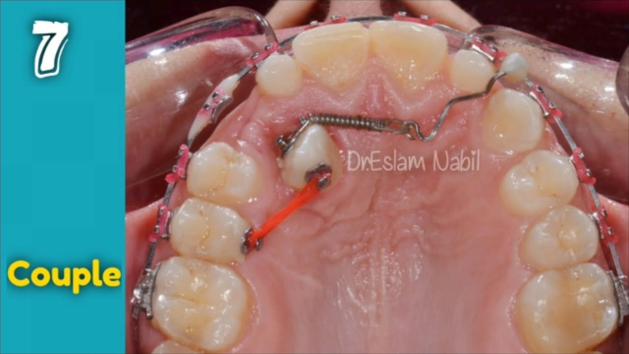 Orthodontic treatment for impacted Canine مراحل تقويم ناب منطمر