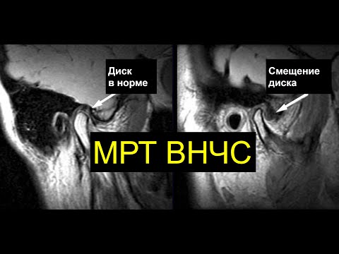 МРТ ВНЧС все секреты от Ивана Комолова (как делать, куда смотреть)