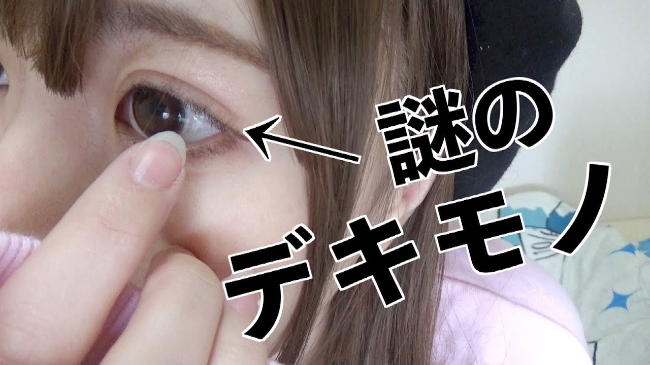 Eligu Info 整形アイドル轟ちゃん 二重整形後のまぶたに異変が