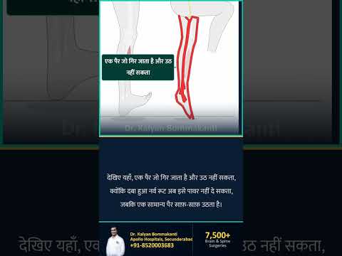 Physio काम नहीं कर रहा स्लिप्ड डिस्क के लिए? — बेस्ट एंडोस्कोपिक स्पाइन सर्जन, हैदराबाद