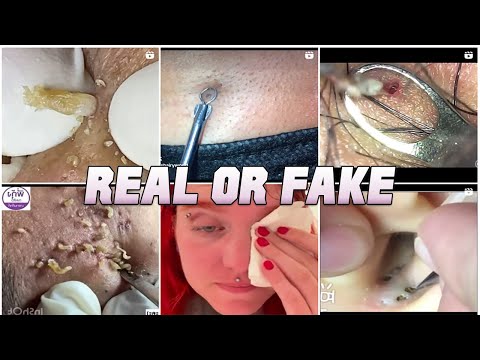 Blackheads and Growths! Real or Fake?