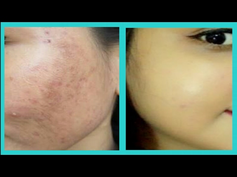 HOW TO REMOVE DARK SPOTS AND ACNE SCARS :  REMEDIES #darkspots #acnescars