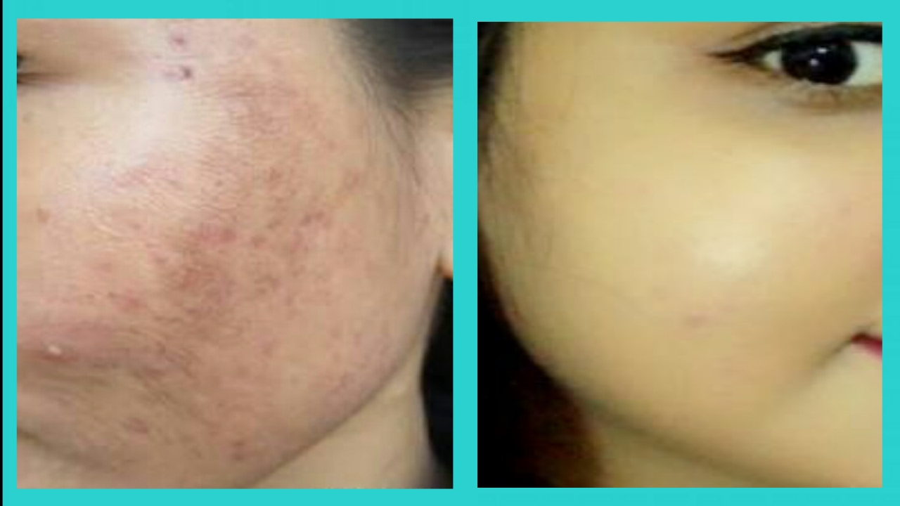 HOW TO REMOVE DARK SPOTS AND ACNE SCARS : 3 REMEDIES #darkspots #