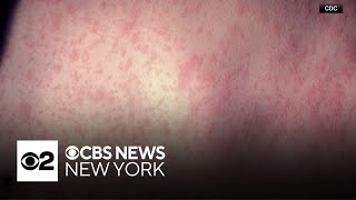 New Jersey health officials confirm another measles case