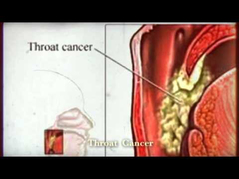 What are common symptoms of throat cancer?