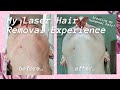 I Got Laser Hair Removal! | Is It Worth It? | My Experience, Aftercare, Honest Review, Opinion