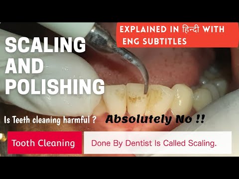 How Scaling is done ? | Teeth cleaning | Scaling and Polishing