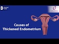 What causes Endometrial thickness? - Dr.Smitha Sha of Cloudnine Hospitals | Doctors&#39; Circle