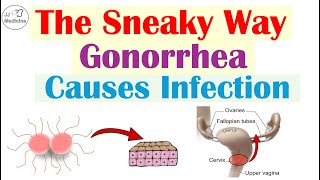 The Sneaky Way Gonorrhea Causes Infection | What Gonorrhea Is and How It Causes Infection
I hope you find this lesson helpful. If you do, please like and subscribe for more lessons like this one!
JJ
**MEDICAL LEGAL DISCLAIMER**: JJ Medicine does not provide medical advice, and the information available on this channel does not offer a diagnosis or advice regarding treatment. Information presented in these lessons is for educational purposes ONLY, and information presented here is not to be used as an alternative to a healthcare professional’s diagnosis and treatment of any person/animal. Only a physician or other licensed healthcare professional are able to determine the requirement for medical assistance to be given to a patient. Please seek the advice of your physician or other licensed healthcare provider if you have any questions regarding a medical condition.
*AFFILIATE DISCLAIMER: This YouTube Channel uses affiliate links and may earn a commission from associated sales.
*IMAGE DISCLAIMER: The content (ex. images) used in this lesson are used in accordance with Fair Use laws and are intended for educational/teaching purposes only*
*Subscribe for more free medical lessons* https://www.youtube.com/channel/UCFPvnkCZbHfBvV8ApBBE0vA?sub_confirmation=1
For books and more information on these topics
https://www.amazon.com/shop/jjmedicine
Support future lessons and lectures ➜ https://www.patreon.com/jjmedicine
Check out the best tool to help grow your YouTube channel (it’s helped me!)
https://www.tubebuddy.com/jjmedicine
Follow me on Twitter! ➜ https://twitter.com/JJ_Medicine
Come join me on Facebook! ➜ https://www.facebook.com/JJ-Medicine-100642648161192/
*Check Out Some of My Other Lessons*
Medical Terminology - The Basics - Lesson 1:
https://www.youtube.com/watch?v=04Wh2E9oNug
Infectious Disease Playlist
https://www.youtube.com/playlist?list=PLRjNoiRtdFwW0Bkc6c66uDACkzotaK26b
Dermatology Playlist
https://www.youtube.com/playlist?list=PLRjNoiRtdFwW3dgORRNmk_MZvnWpZx_lW
Pharmacology Playlist
https://www.youtube.com/playlist?list=PLRjNoiRtdFwWPWcV9lZTh-Qxv0gYakQXR
Hematology Playlist
https://www.youtube.com/playlist?list=PLRjNoiRtdFwW8Ajo1dmxdj4EYEKcbtGju
Rheumatology Playlist
https://www.youtube.com/playlist?list=PLRjNoiRtdFwWDvuhasXsuTFXJp05wwUle
Endocrinology Playlist
https://www.youtube.com/playlist?list=PLRjNoiRtdFwUuRSzhploohnaWVvbVZ7ZP
Nephrology Playlist
https://www.youtube.com/playlist?list=PLRjNoiRtdFwXRSwrFQK5WwWZLk1Las8v8
Fatty Acid Synthesis Pathway:
https://www.youtube.com/watch?v=WuQS_LpNMzo
Wnt/B Catenin Signaling Pathway:
https://www.youtube.com/watch?v=NGVP4J9jpgs
Upper vs. Lower Motor Neuron Lesions:
https://www.youtube.com/watch?v=itNd74V53ng
Lesson on the Purine Synthesis and Salvage Pathway:
https://www.youtube.com/watch?v=e2KFVvI8Akk
Gastrulation | Formation of Germ Layers:
https://www.youtube.com/watch?v=d6Kkn0SECJ4
Introductory lesson on Autophagy (Macroautophagy):
https://www.youtube.com/watch?v=UmSVKzHc5yA The Sneaky Way Gonorrhea Causes Infection | What Gonorrhea Is and How It Causes Infection
