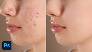 How To Easily Remove Acne & Blemishes In Photoshop
