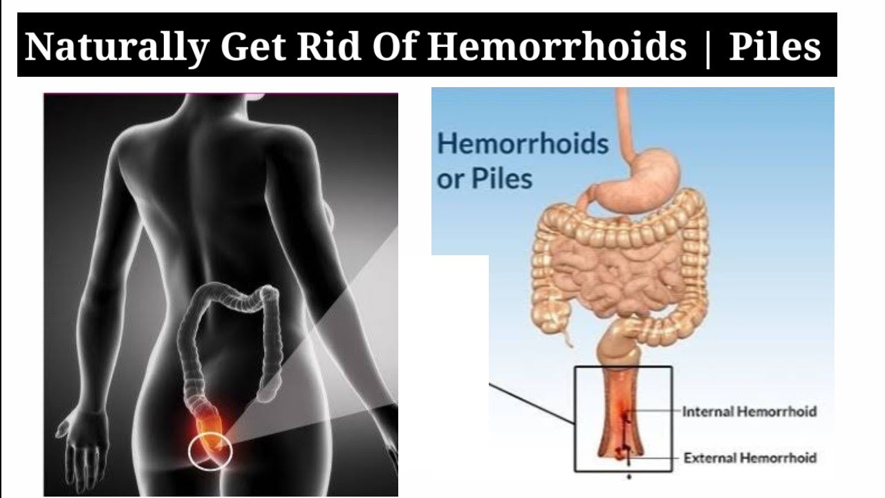 Hemorrhoids | Piles : How To Get Rid Of Hemorrhoids | Hemorrhoids