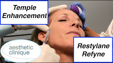 Temple Enhancement with Restylane Refyne