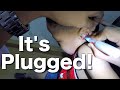 Removing Little Boy's Huge Earwax Plug