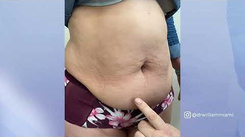 Should I Get a Tummy Tuck or a BBL