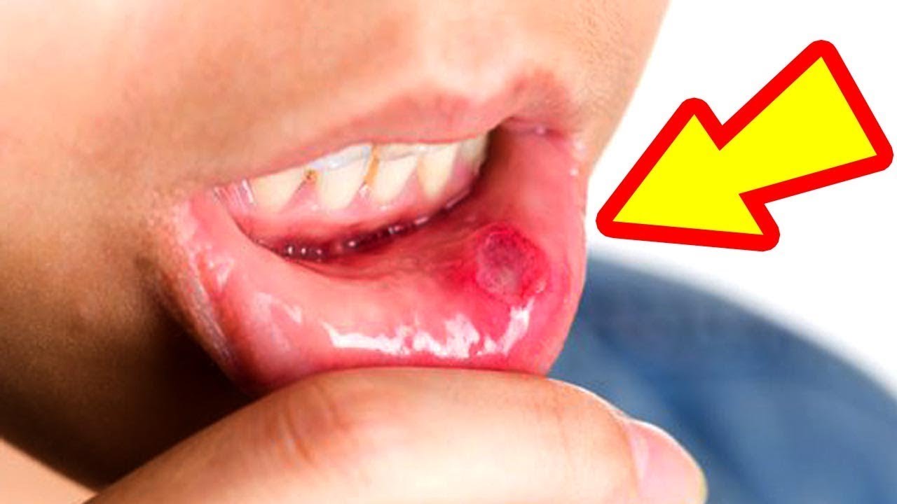 Por qué salen llagas en la lengua
