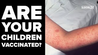 Ohio health officials warn of measles spread