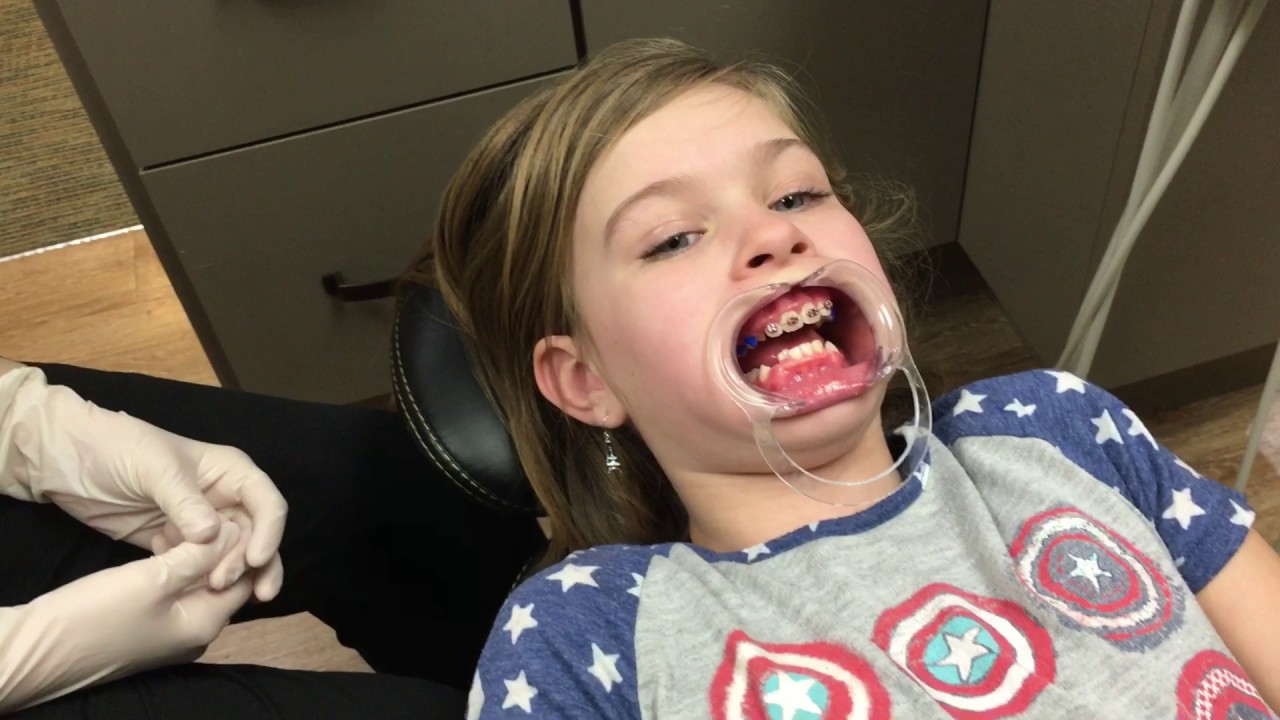 Lily gets MORE braces on! YouTube