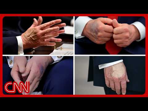 Trump's physical exam: What doctors are watching for