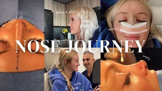 I GOT A NOSE JOB... MY ENTIRE RHINOPLASTY RECOVERY + RESULTS with one of the BEST SURGEONS!